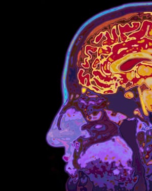 Research suggests between 20 and 30 genes are involved in predisposing people to Alzheimer’s.