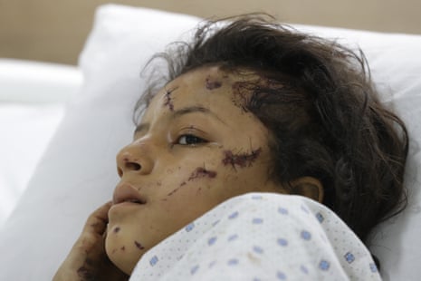 A girl, wounded in an Israeli strike, receives treatment in the southern Lebanese village of Saksakiyeh.
