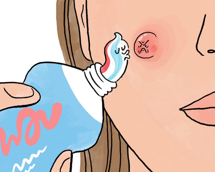 Image accompanying the story: Is it true that … toothpaste is an effective spot treatment?
