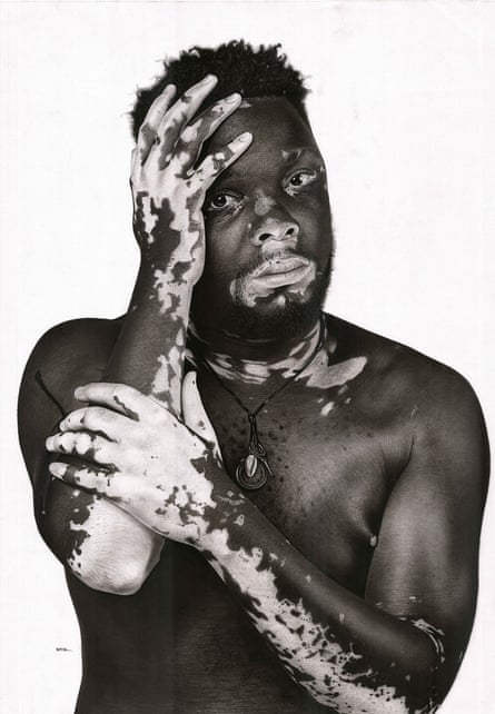 445px x 642px - Embracing vitiligo: Ugandan artist dispels skin stigma with portraits |  Global development | The Guardian