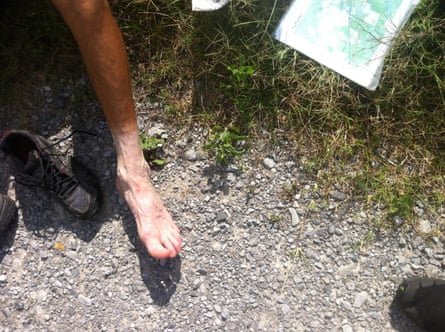 Nimblewill Nomad’s foot after hiking. He had his nails surgically removed.
