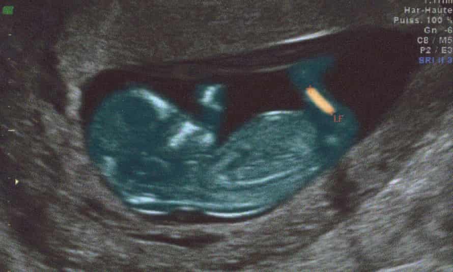 Ultrasound scan of a 30-year-old woman in her second month of pregnancy. 