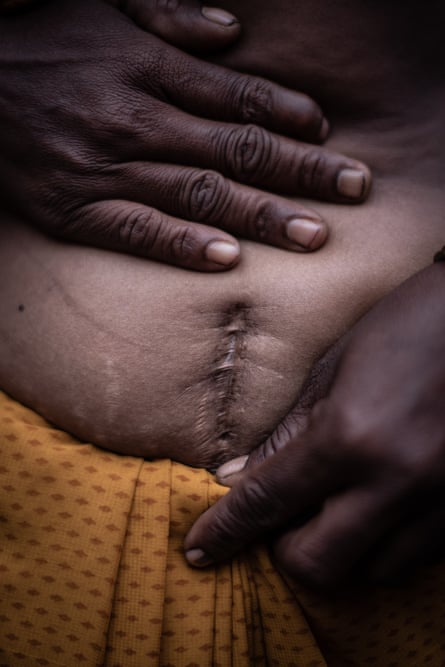 A woman’s stomach with a vertical hysterectomy scar below the navel.
