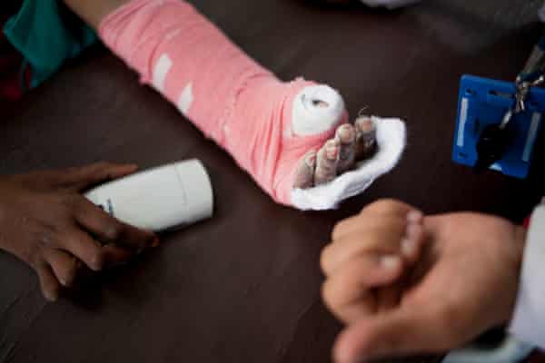 The Harder You Look The More You Find Nepal S Hidden Leprosy Rebecca Ratcliffe Global Development The Guardian