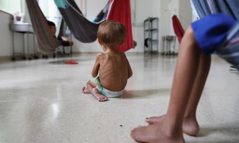 A malnourished Yanomani toddler