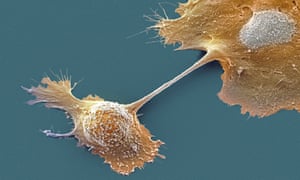 Scanning electron microscope image of pancreatic cancer cells.