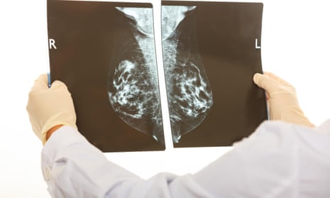 Doctor holds mammogram