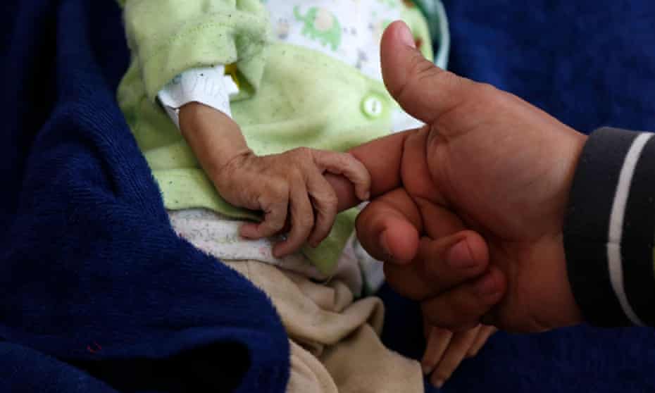 A malnourished child at Al-Sabeen hospital in Sana’a, Yemen, November 2020. 