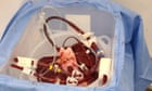 Experimental use of pig liver to filter blood externally offers hope for patients