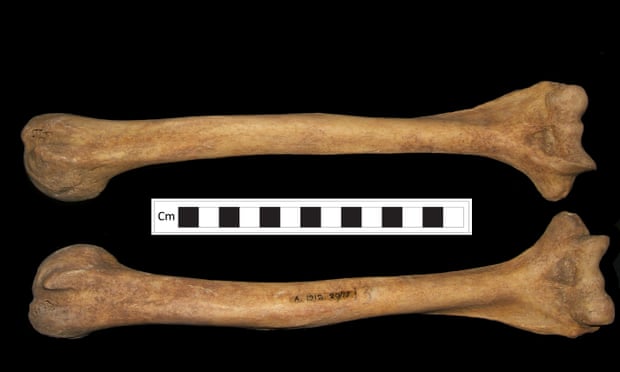 Deformities in the woman’s bones correspond to the symptoms of rickets.