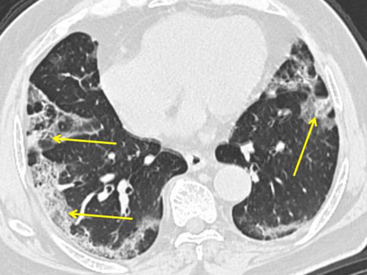 Lungs after covid