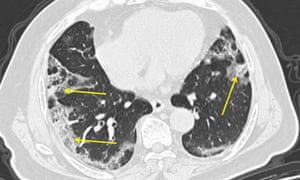 A CT scan of a man with Covid-19. The pneumonia it causes can show up as distinctive hazy patches on the outer edges of the lungs, indicated by arrows.