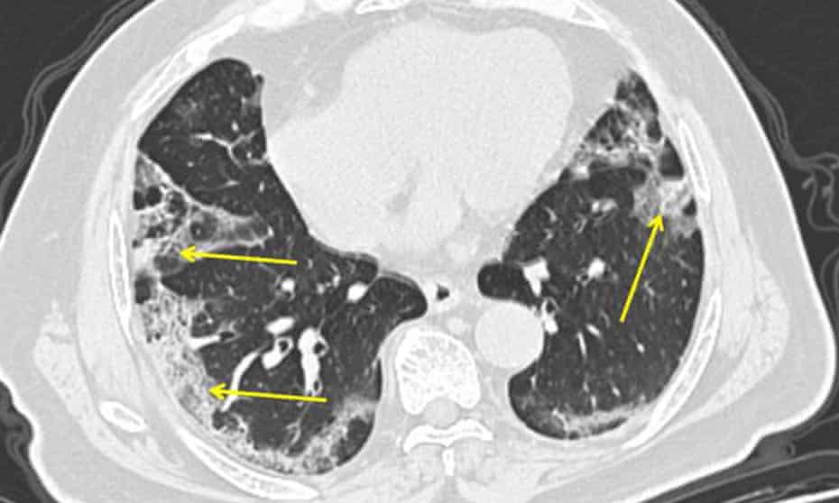 Respiratory physician John Wilson explains the range of Covid-19 impacts. This image shows a CT scan from a man with Covid-19. Pneumonia caused by the new severe acute respiratory coronavirus 2 can show up as distinctive hazy patches on the outer edges of the lungs, indicated by arrows.