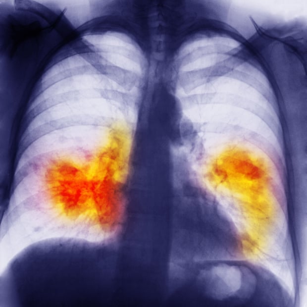 Chest x-ray showing lung cancer.