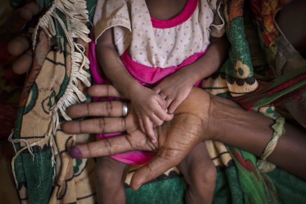 A woman holds her malnourished daughter at a clinic in Tigray, northern Ethiopia.