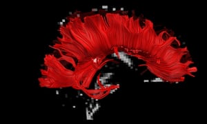A DTI image of the corpus callosum, as seen from the side, is shown in red on and superimposed on a background MRI image of the brain.