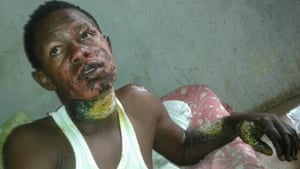 Jacob Viera bears the scars of the deliberate electric shock inflicted in his native Kenya that almost ended his life