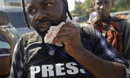 Photojournalist Dieu Nalio Chery holds a healing gauze next to his mouth.
