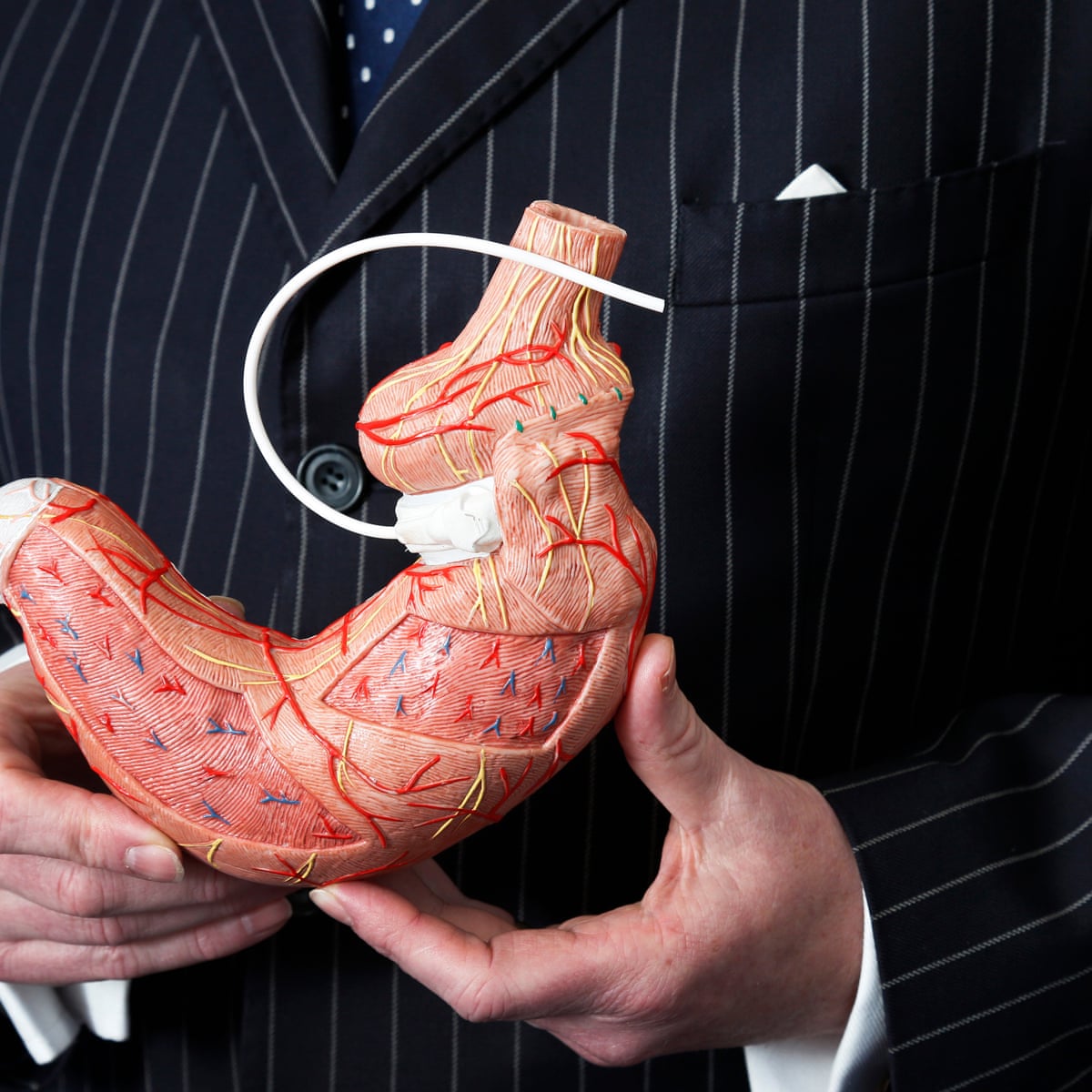 weight loss surgery transformed my life