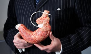 Image result for bariatric surgery