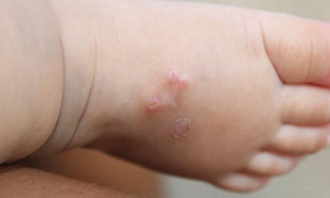 A baby’s foot with signs of scabies infection