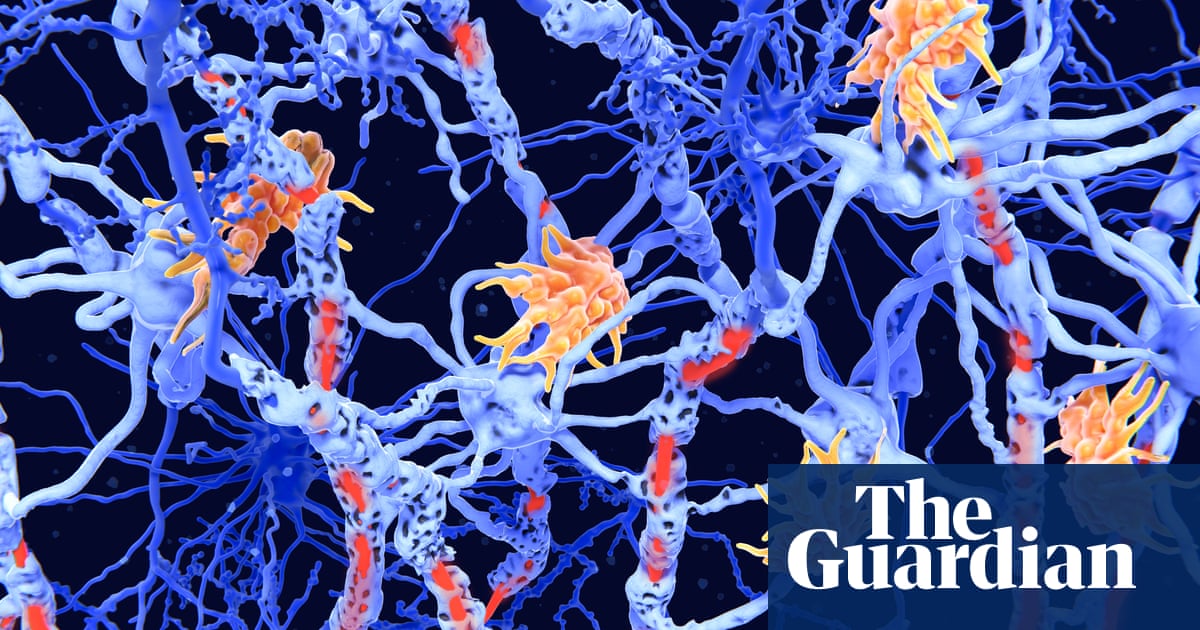 Inverse vaccines': the promise of a holy grail' treatment for autoimmune diseases