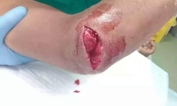 Deep gashes are shown on the arm of a refugee on Manus Island who was allegedly attacked with knives by locals last week.