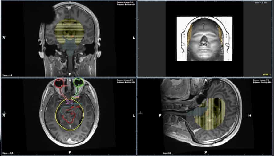 A planning MRI scan shows the brain of the young patient with an aggressive brain tumour.