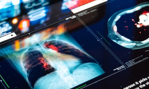 Picture of lung cancer appearing red on a medical scan like an X-ray