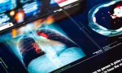 Medical MRI Scan on digital screen lung cancer