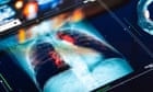 Progress on cancer survival in UK at slowest in 50 years, study finds