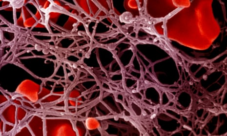 Human blood clots: people suffering from haemophilia A are missing a single gene that causes blood to clot.