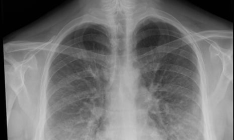 This chest x ray shows lung opacities, densities or whitish cloud-like areas which are typically seen with pneumonias or lung inflammation.