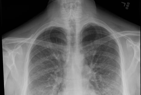 A chest X-ray shows lung opacities, densities or whitish cloud-like areas which are typically seen with unusual pneumonias, fluid in lungs or lung inflammation.