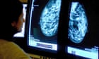 Fears England breast cancer deaths may rise as Covid hits screenings