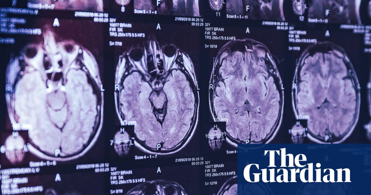 Mystery brain disorder baffles Canadian medicine