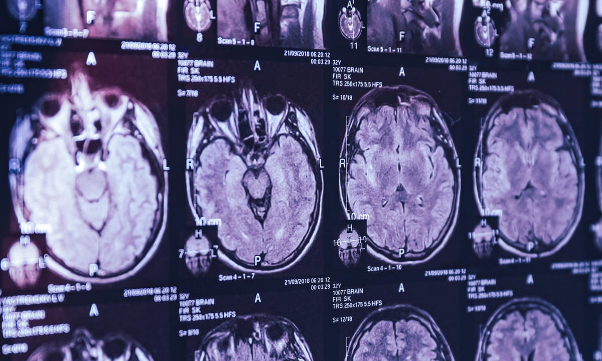 Mystery Brain Disorder Baffles Canadian Doctors Canada The Guardian Mystery Brain Disorder Baffles Canadian Doctors Canada The Guardian