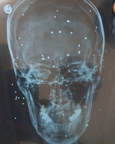 An X-ray image provided by an Iranian doctor of a skull showing pellets from a shotgun round.