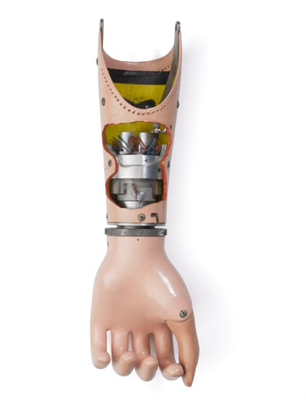 A carbon dioxide-powered hand prosthesis that uses two small, rolling sleeve valves that complement the lower arm with a wrist rotating axis.