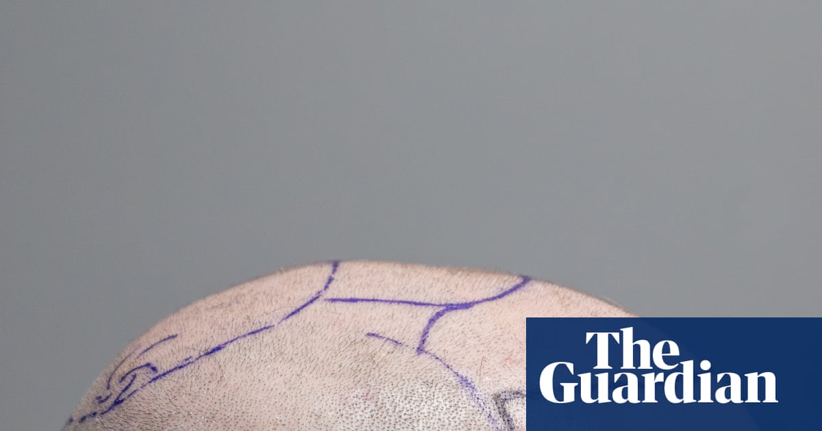 Hair apparent: inside the transplant capital of the world – photo essay