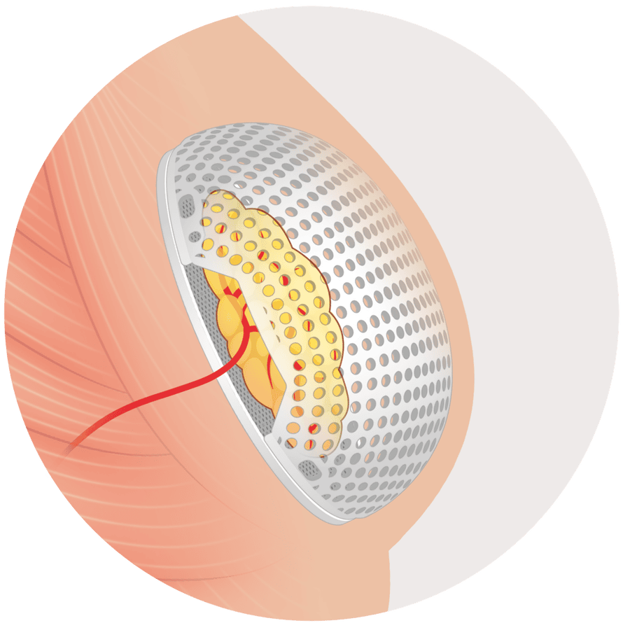 Lattice Medical’s Mattisse implant