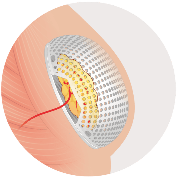 Lattice Medical’s Mattisse implant