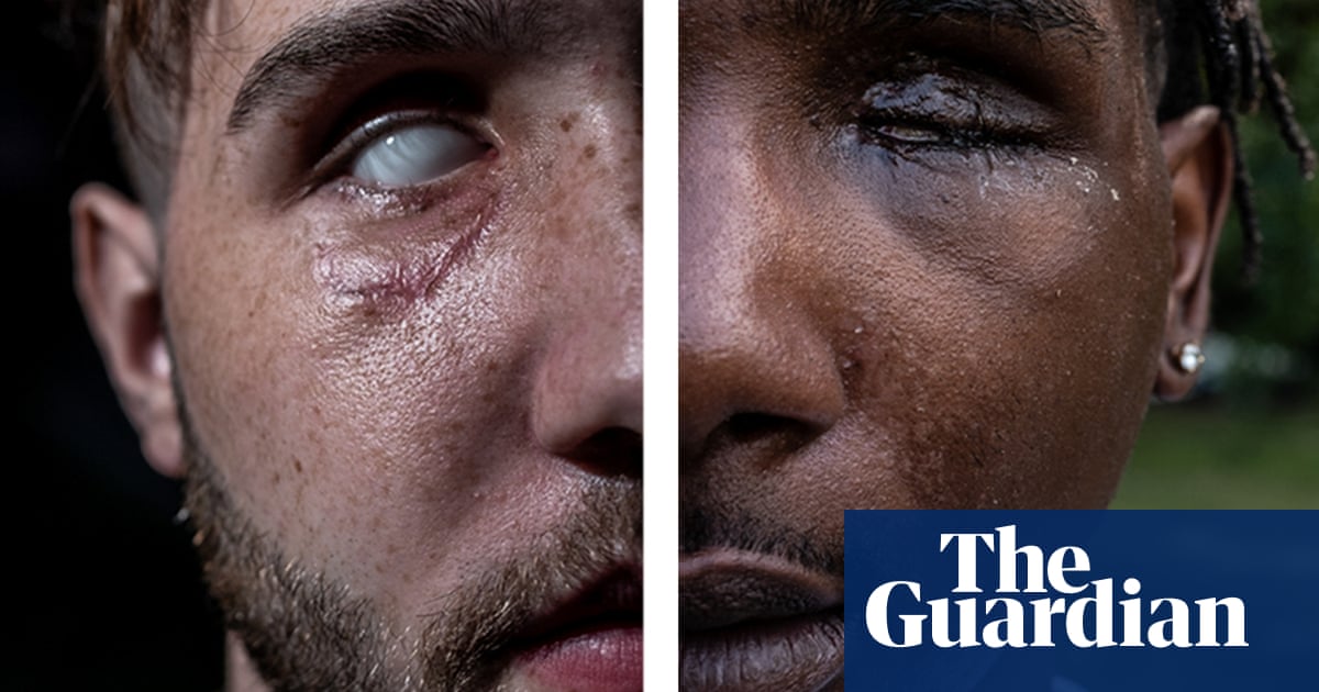 ‘Blinded by police’: my search for fellow survivors of an alarming trend
