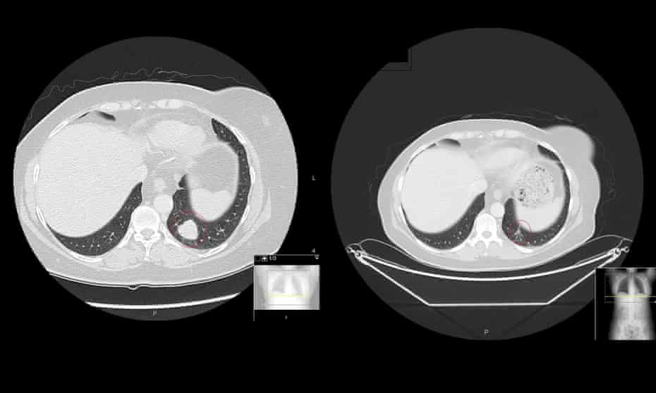 Royal Marsden patient Vicky Brown’s CT scan before treatment (left) and 12 weeks after initial treatment.