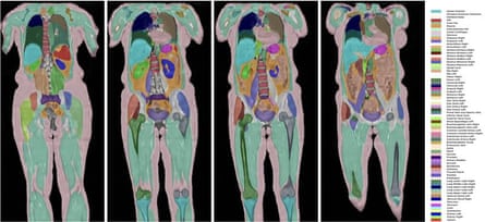 A series of abdominal scans of human bodies, showing organs and bones
