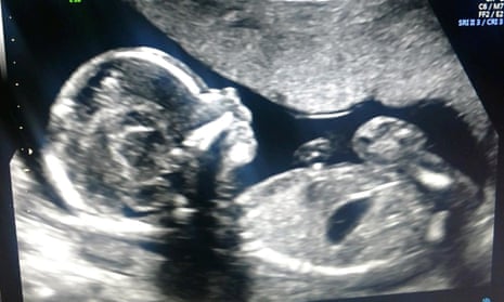 ultrasound of a human foetus