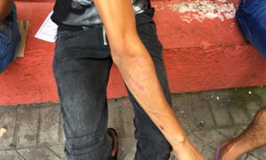 The hand of a Moroccan Amazigh refugee, scarred after being beaten by Moroccan police