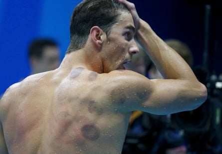 Michael Phelps is seen with red cupping marks on his shoulder as he competes.