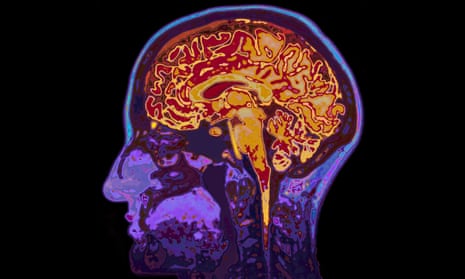 An MRI image of a brain