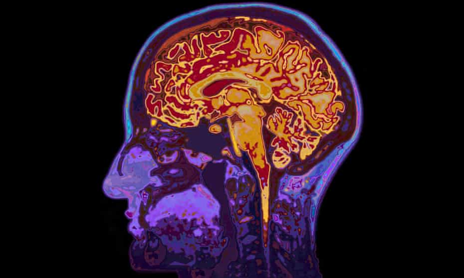 An MRI scan showing a patient’s brain